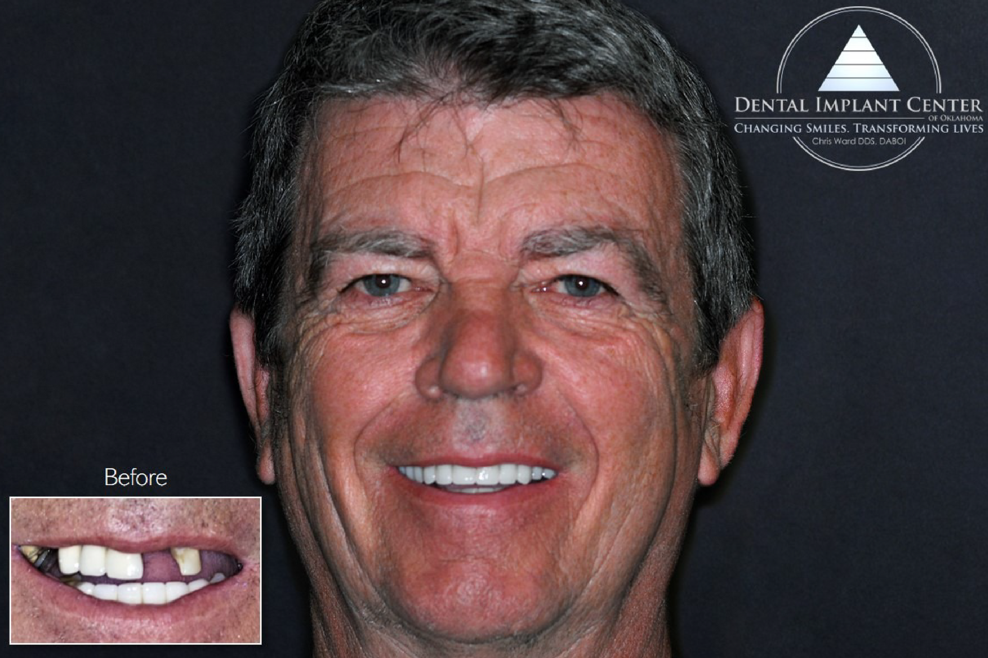 Dental Implant Center of Oklahoma - Before and After