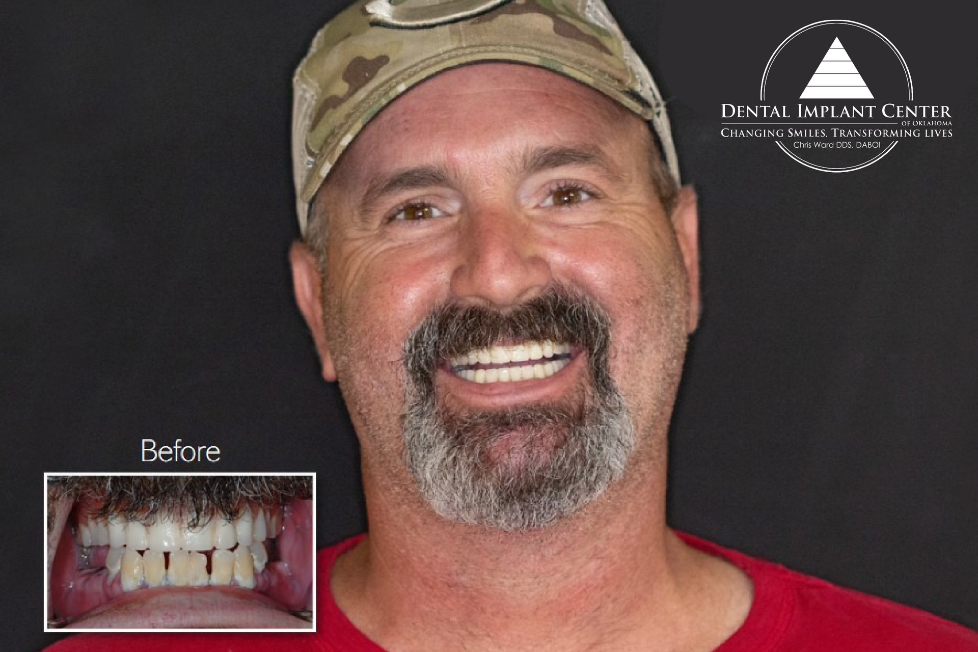 Dental Implant Center of Oklahoma - Before and After