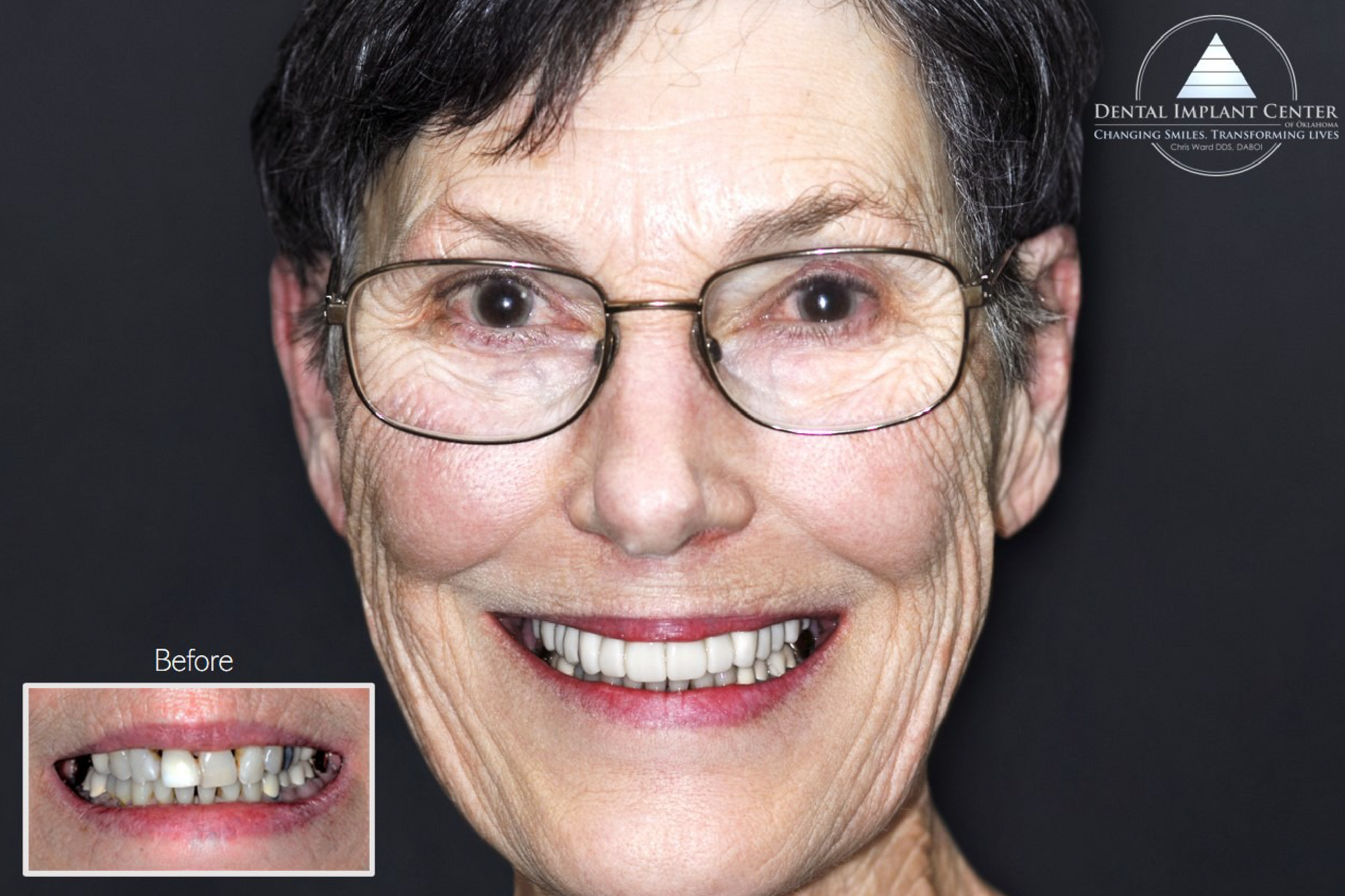 Dental Implant Center of Oklahoma - Before and After
