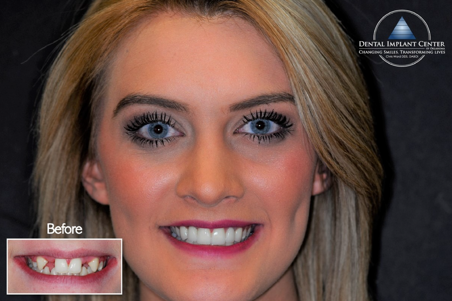 Dental Implant Center of Oklahoma - Before and After