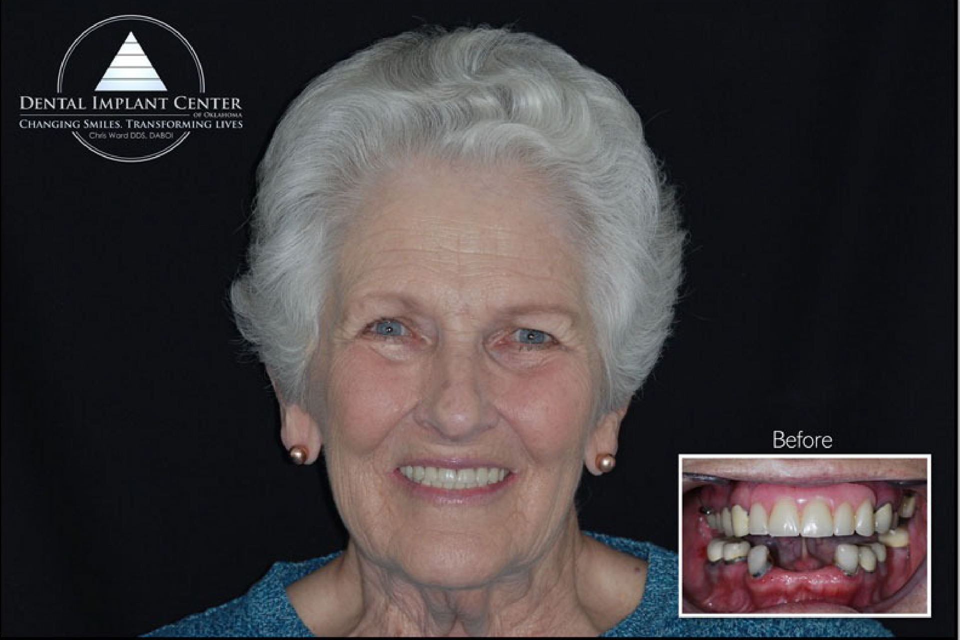 Dental Implant Center of Oklahoma - Before and After