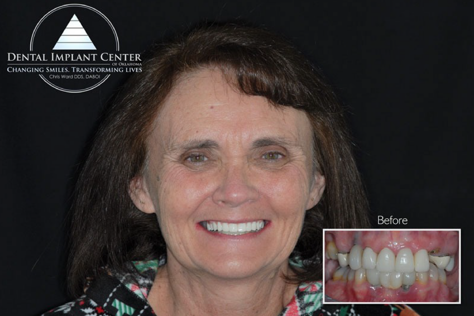 Dental Implant Center of Oklahoma - Before and After