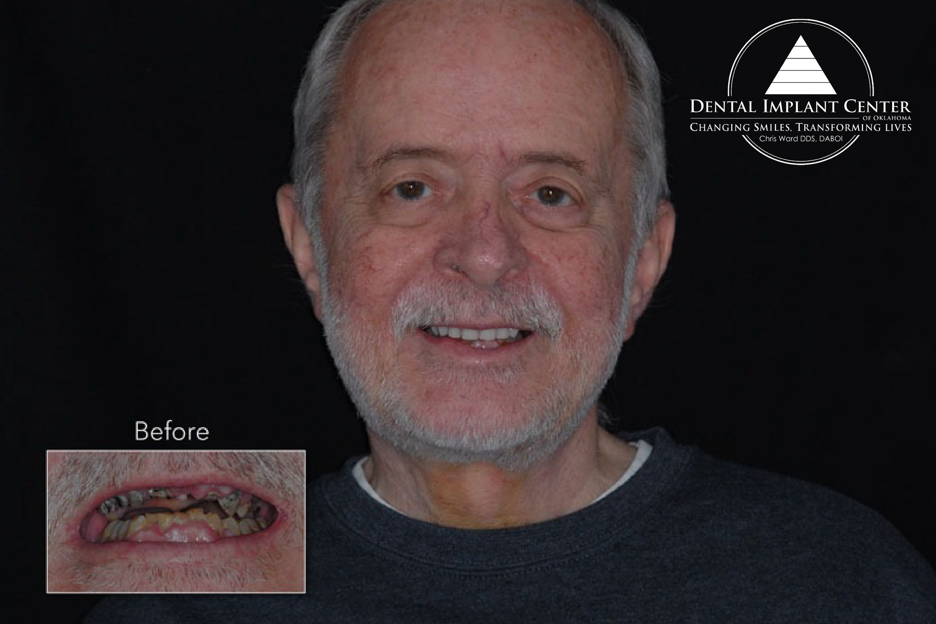Dental Implant Center of Oklahoma - Before and After