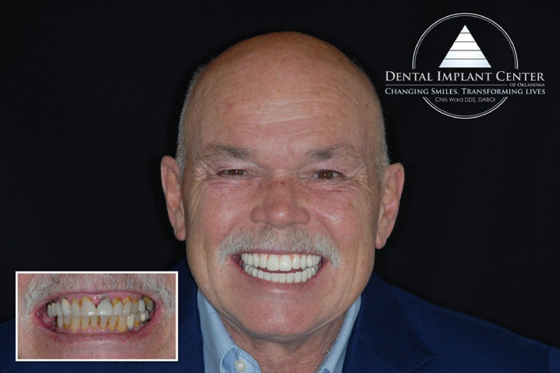 Dental Implant Center of Oklahoma - Before and After