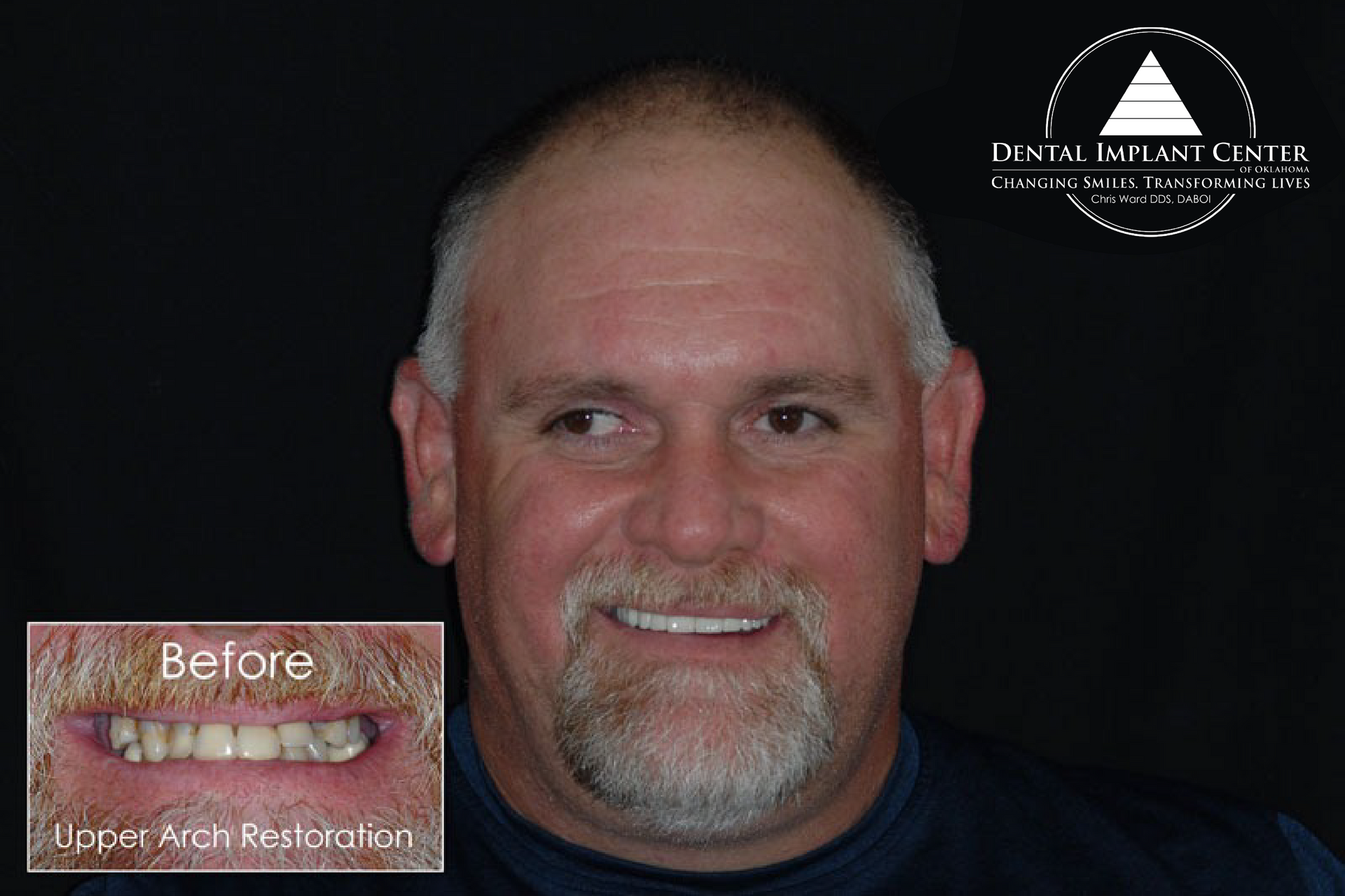 Dental Implant Center of Oklahoma - Before and After