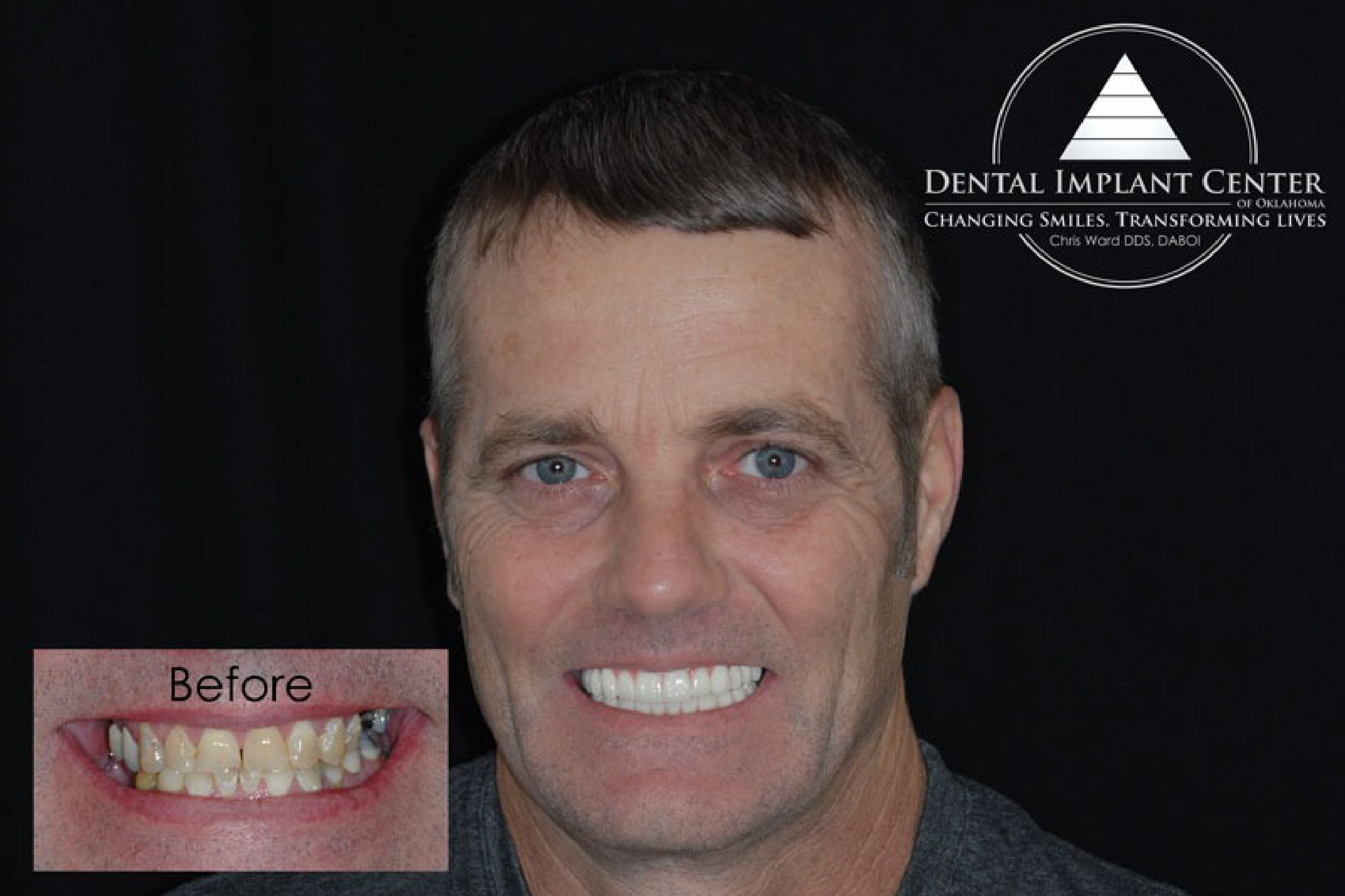 Dental Implant Center of Oklahoma - Before and After