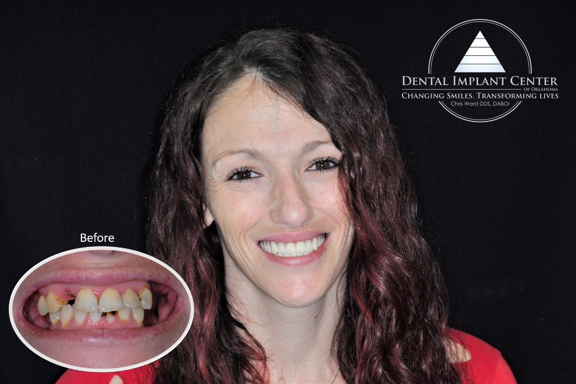 Dental Implant Center of Oklahoma - Before and After