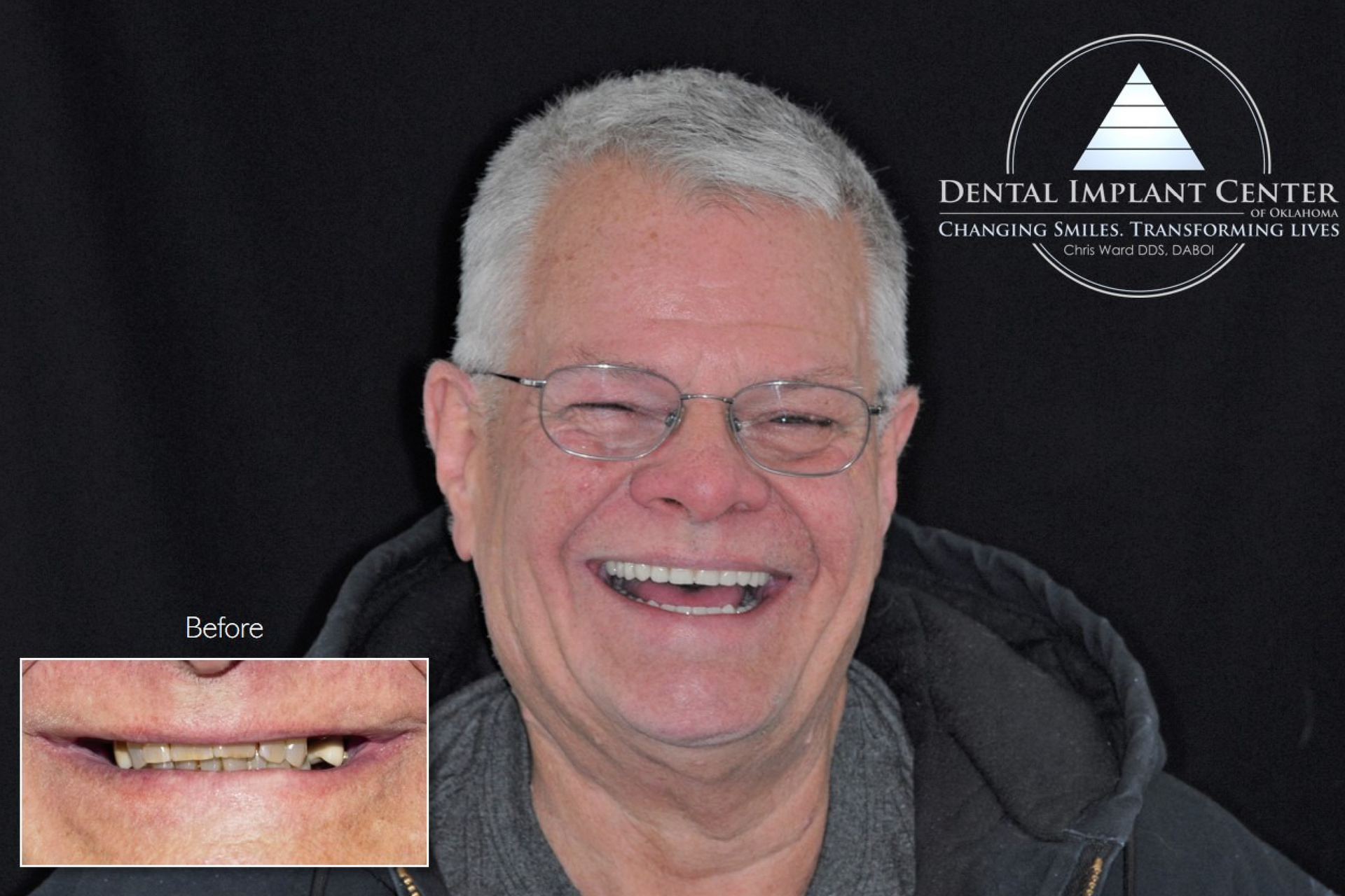 Dental Implant Center of Oklahoma - Before and After