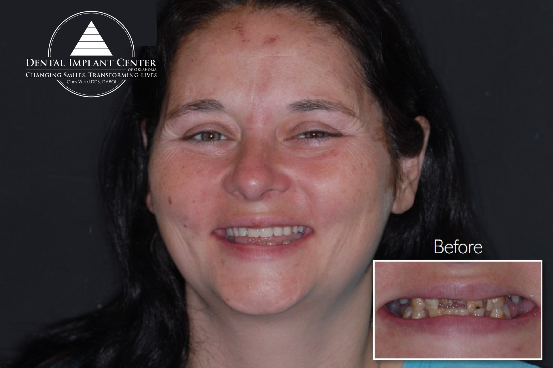 Dental Implant Center of Oklahoma - Before and After