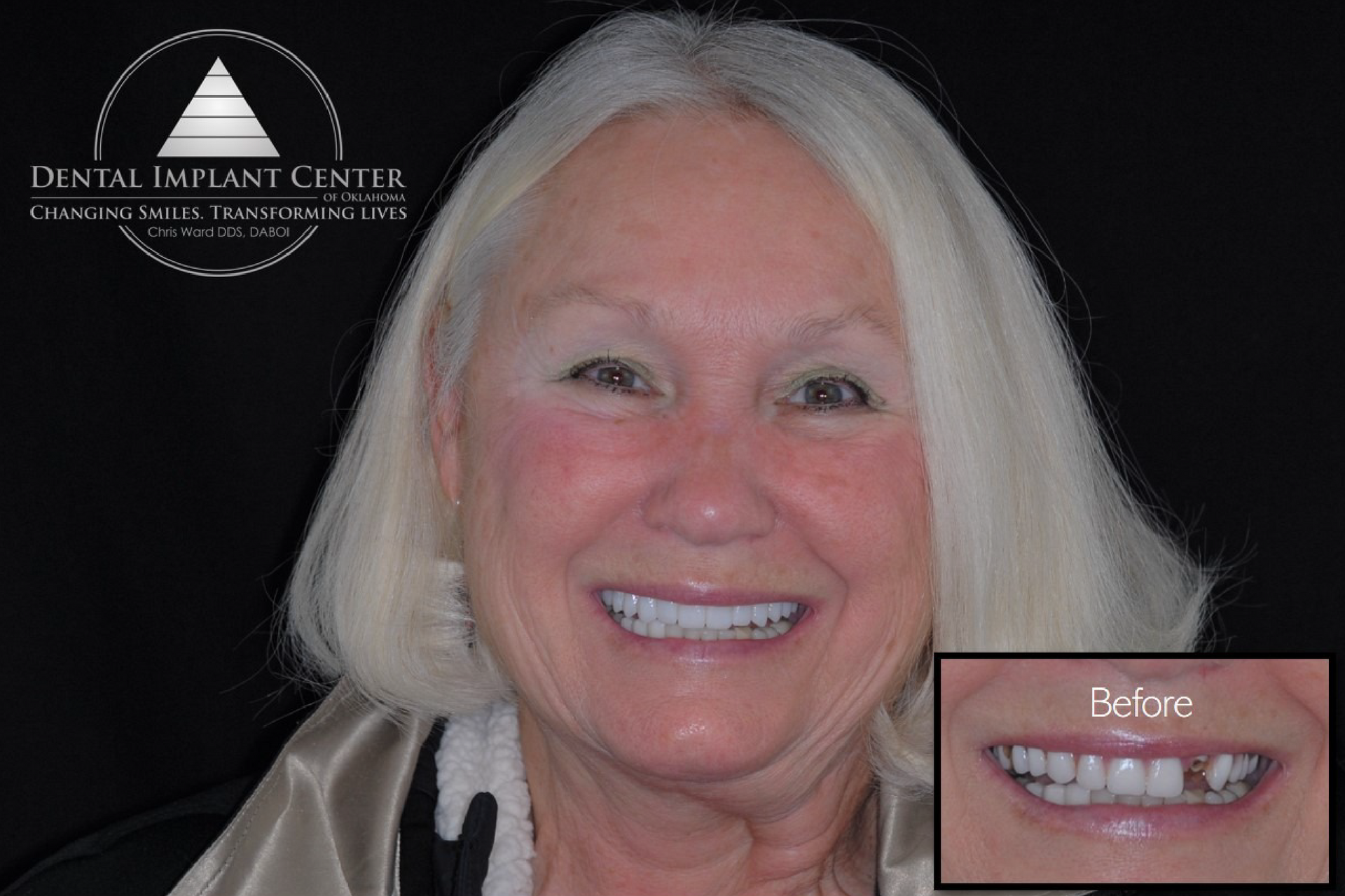 Dental Implant Center of Oklahoma - Before and After