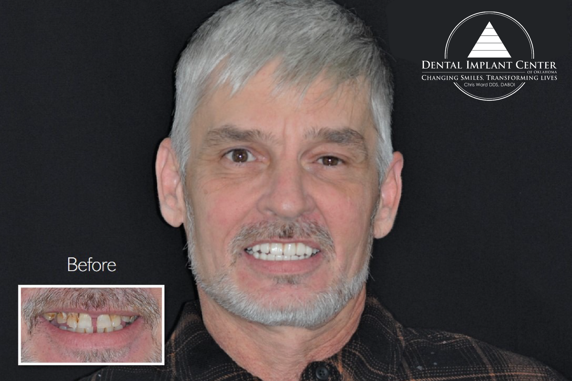Dental Implant Center of Oklahoma - Before and After
