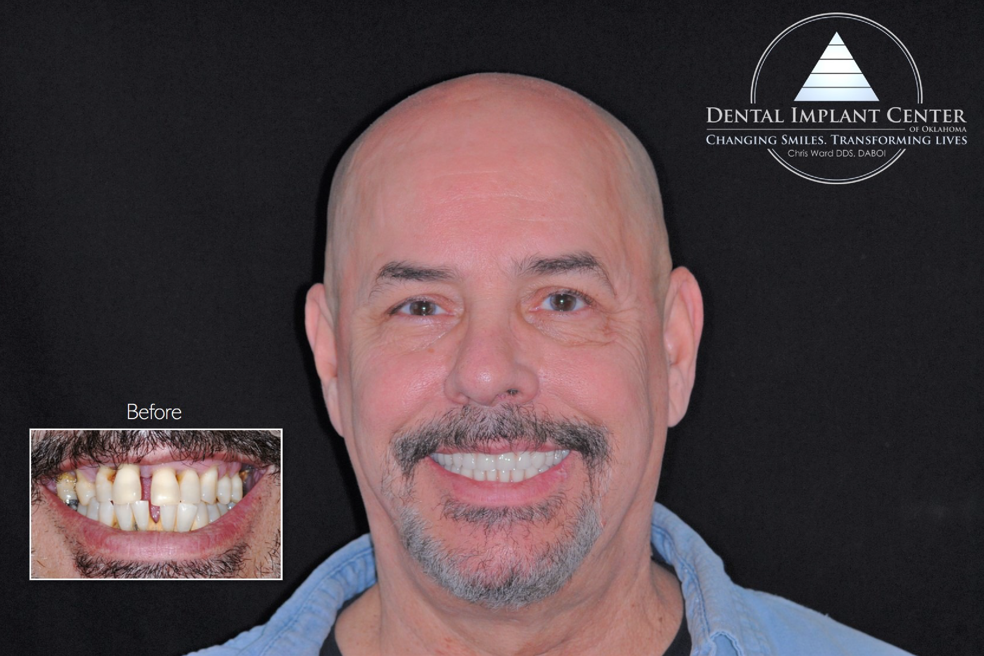 Dental Implant Center of Oklahoma - Before and After