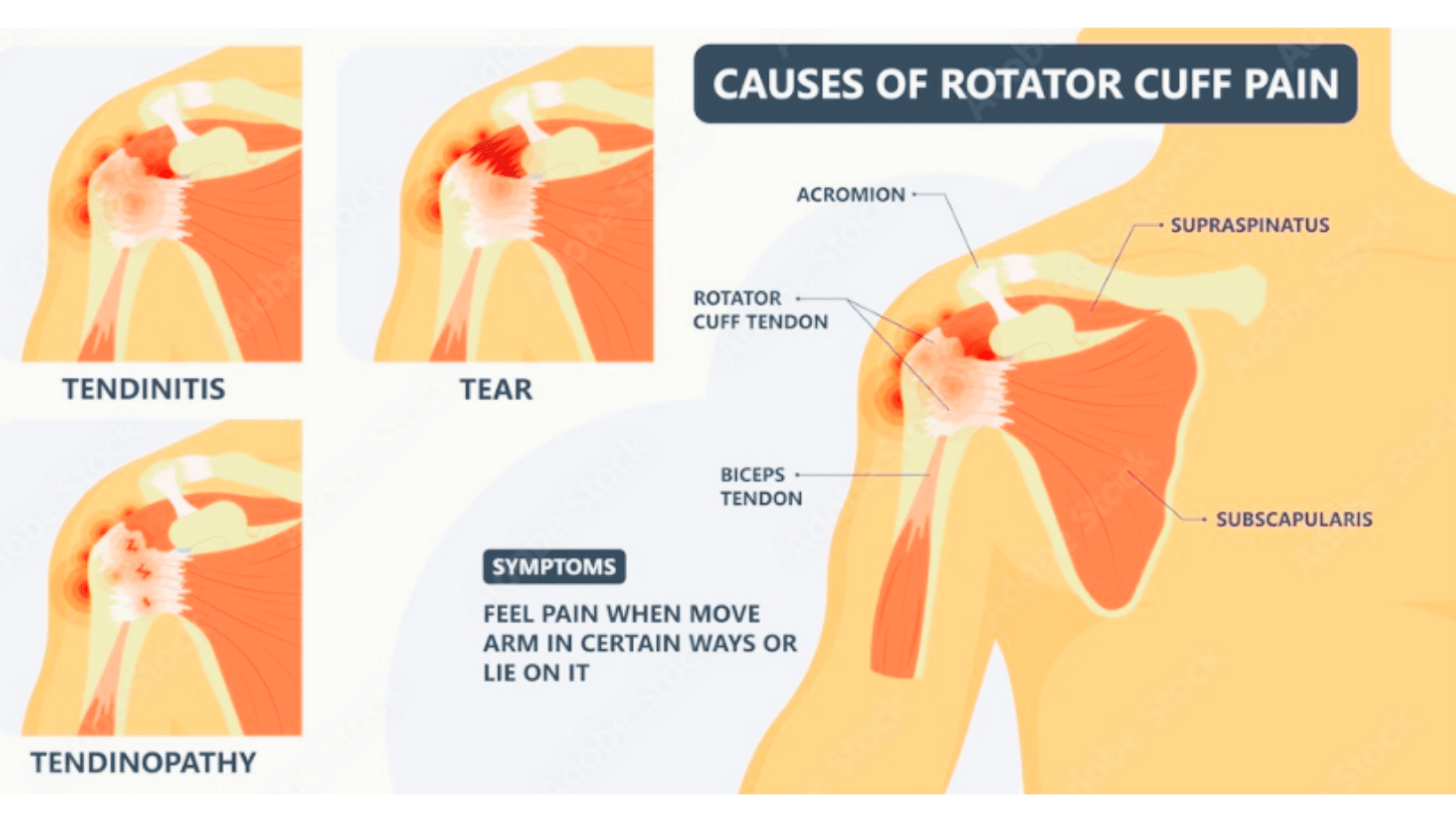 Tips For Treating Rotator Cuff Injuries Surgeon Researcher