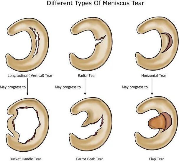 Different type of meniscus tears