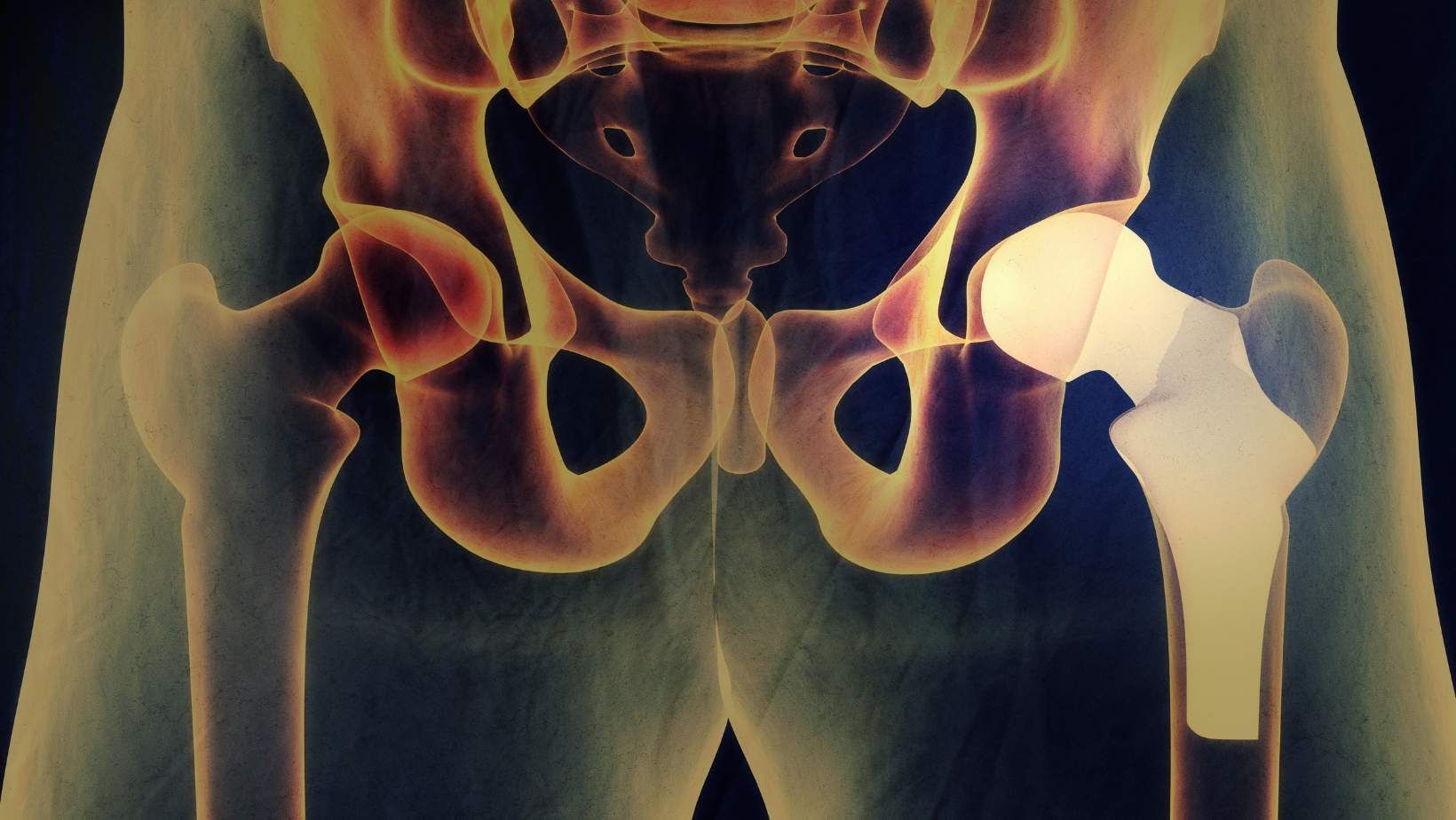 Hip Surgery for the Elderly