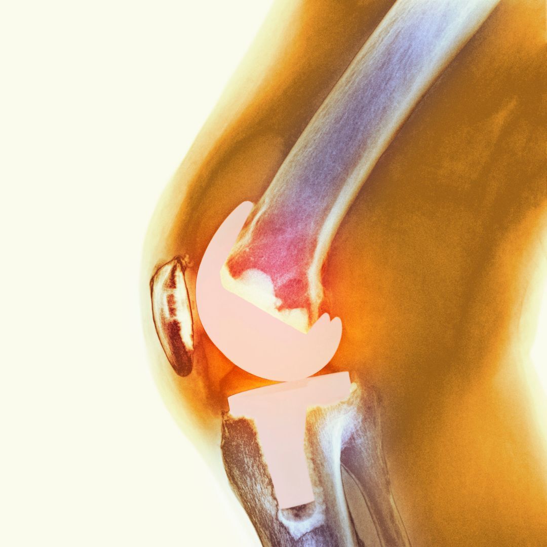 Knee Arthroplasty