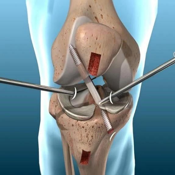 Meniscal repair image