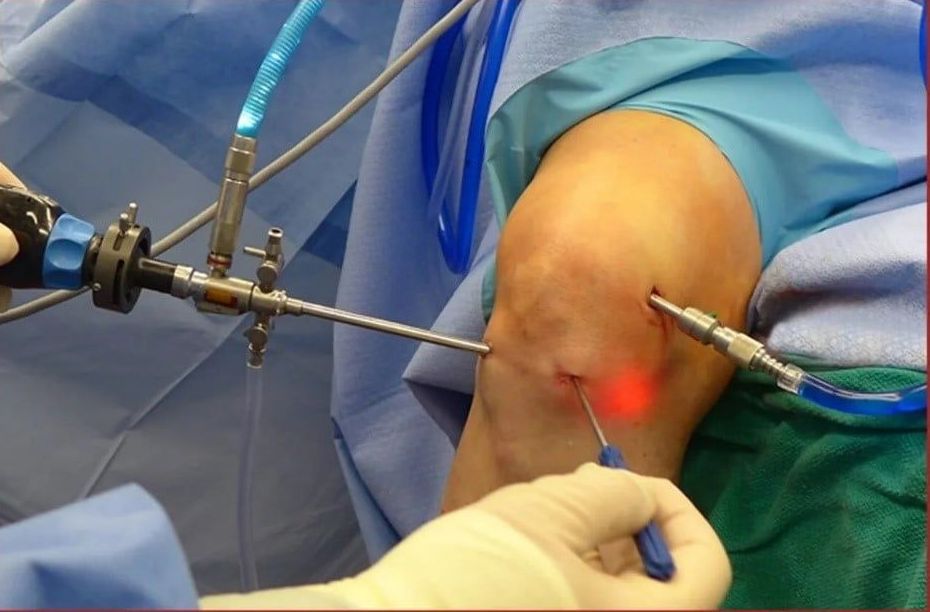 Meniscal Repair - Before Surgery