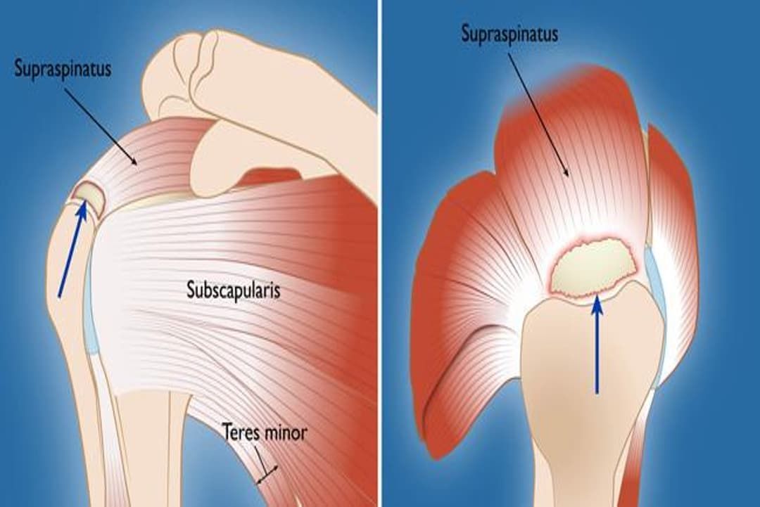 Rotator Cuff Repair | Surgeon Researcher