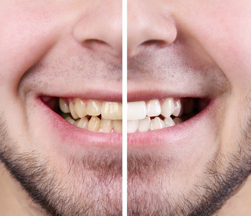 Sbiancamento dentale prima e dopo