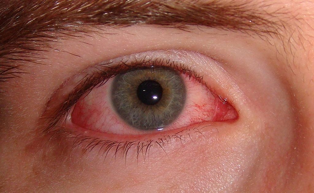 Alergia al humo: cómo lidiar con los síntomas alérgicos