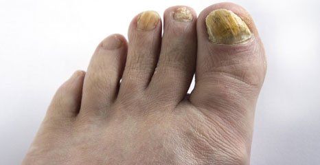 Cold Laser for Fungal Nails and Skin (athletes’ foot):