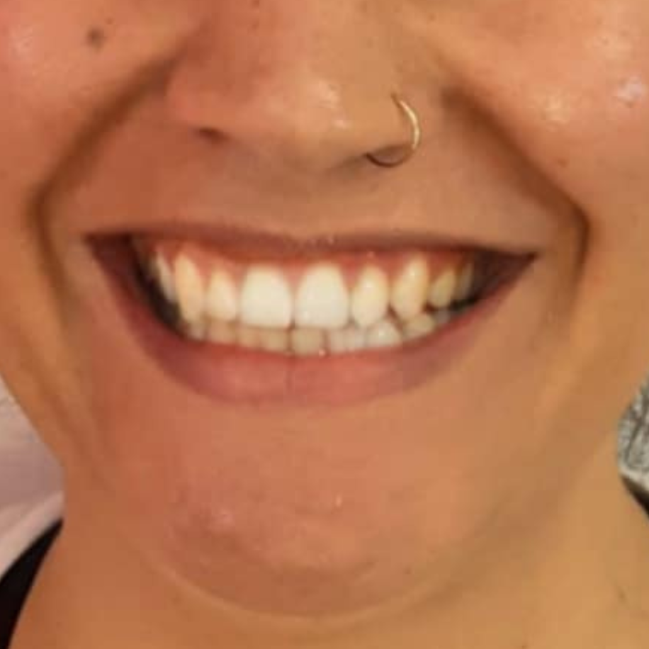 lip-filler-auckland
