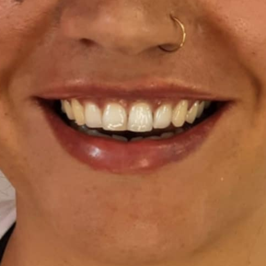 lip filler sublime571 Auckland