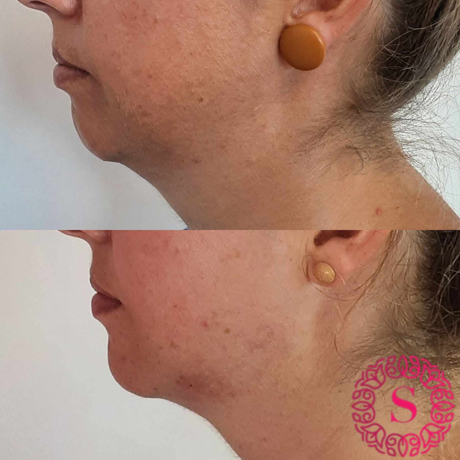 Chin enhancement dermal filler Sublime571