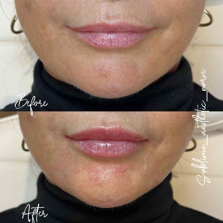 sublime aesthetic nurse lip filler