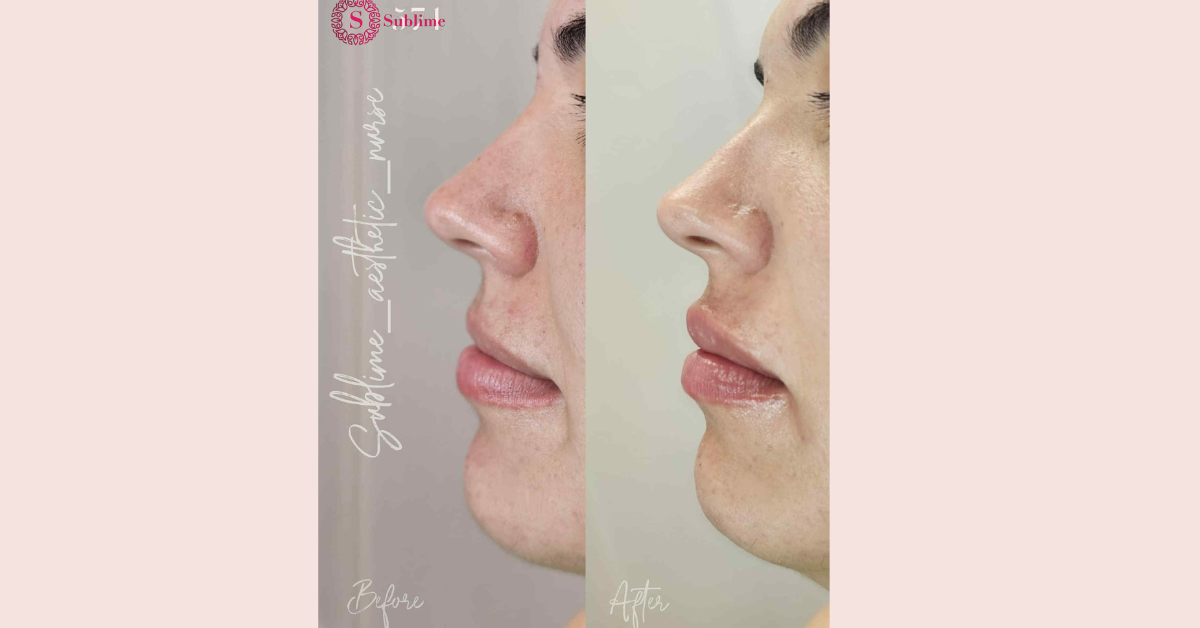Balancing Lip Proportions with Dermal Filler: Natural Results at ...