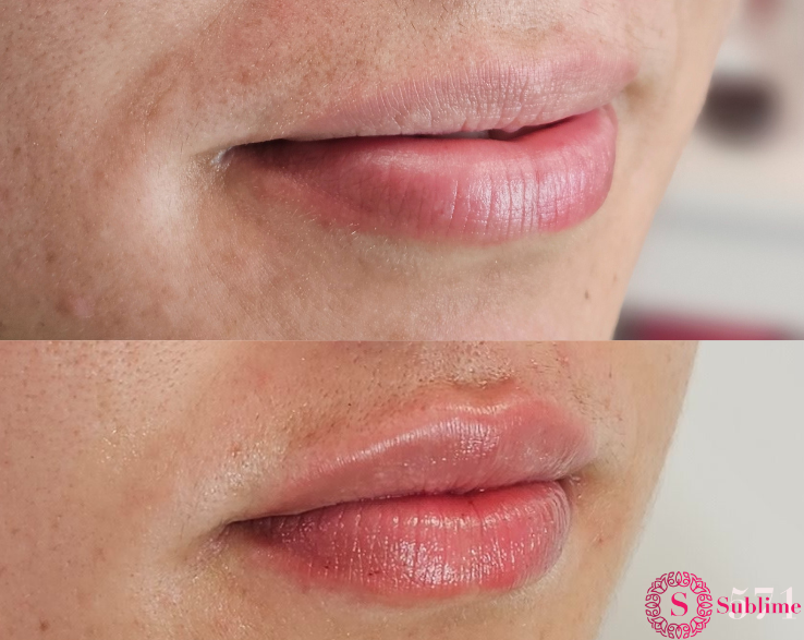 Lip volume dermal filler Auckland