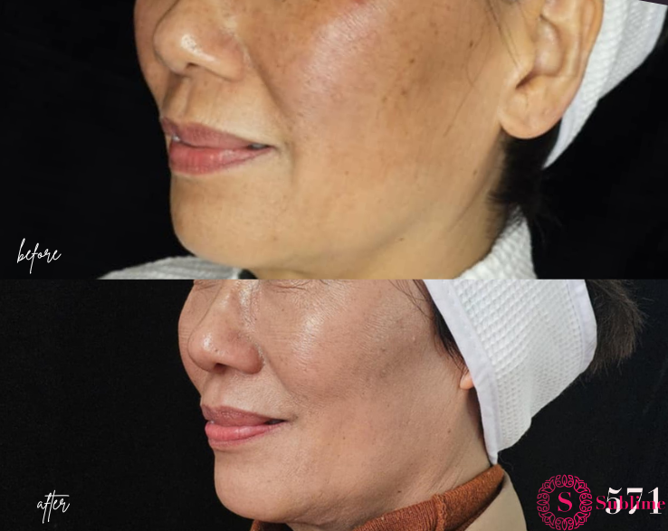 Chin enhancement dermal filler Sublime571