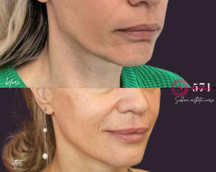 before and after sculptra and dermal filler