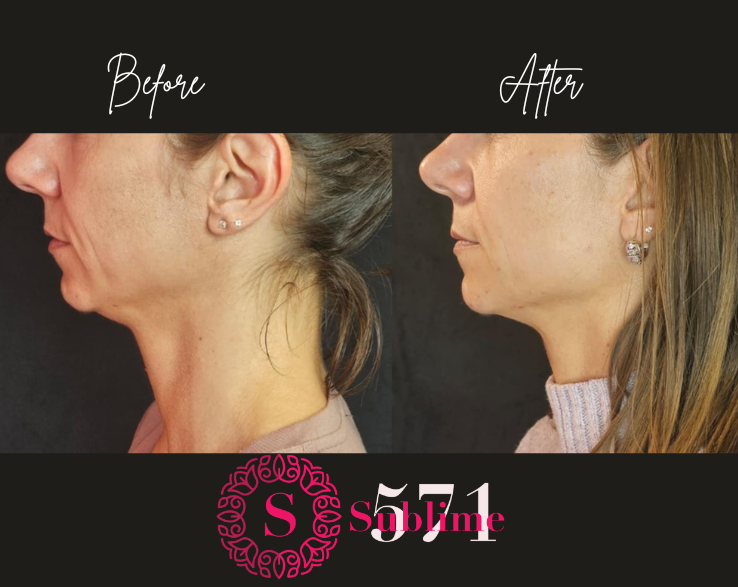 Sculptra for volumisataion Auckland