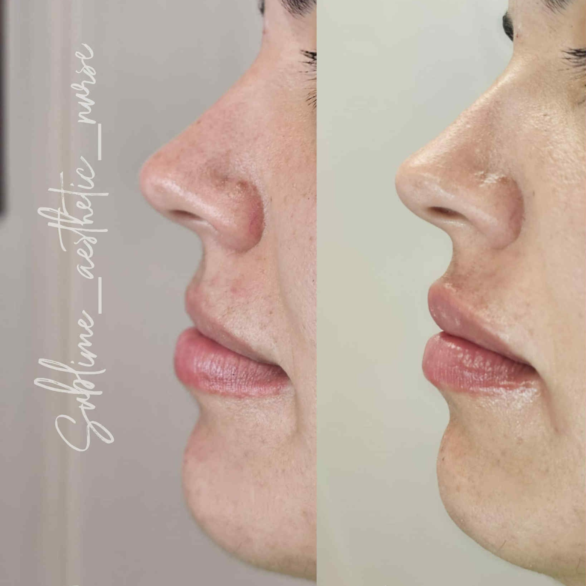 Lip filler Silverdale Auckland