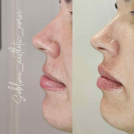 Lip filler Silverdale Auckland