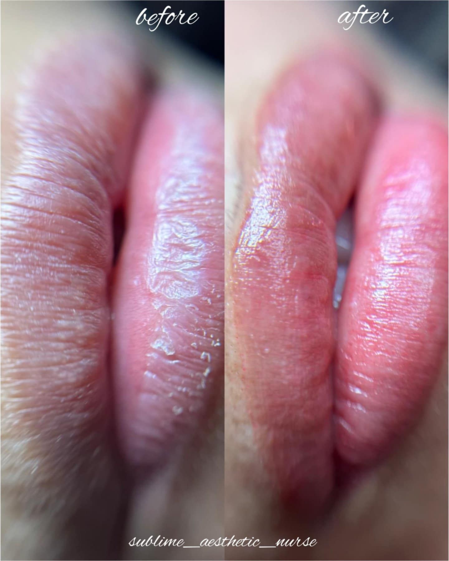 Before and after Aquarelle Lip Blush treatment at Sublime 571 clinic