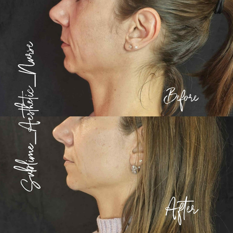 Sculptra auckland