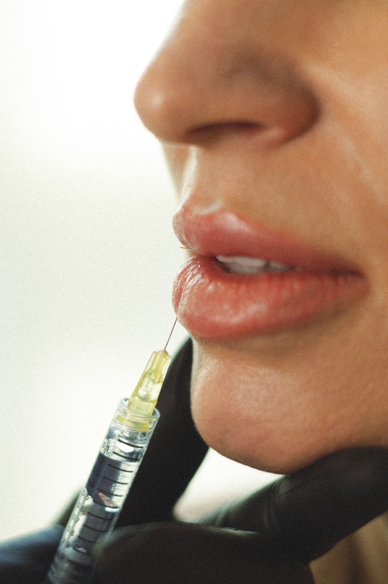 Fillers and Biostimulators