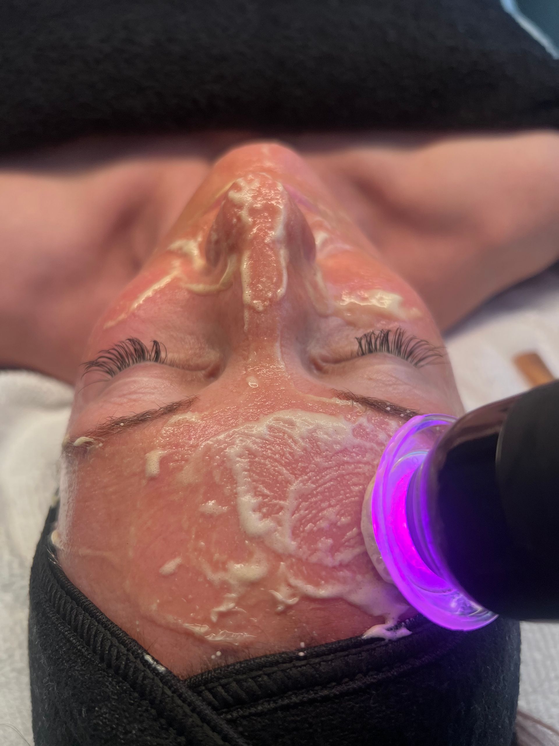 Person receiving a facial treatment with a purple light device and cream on the face