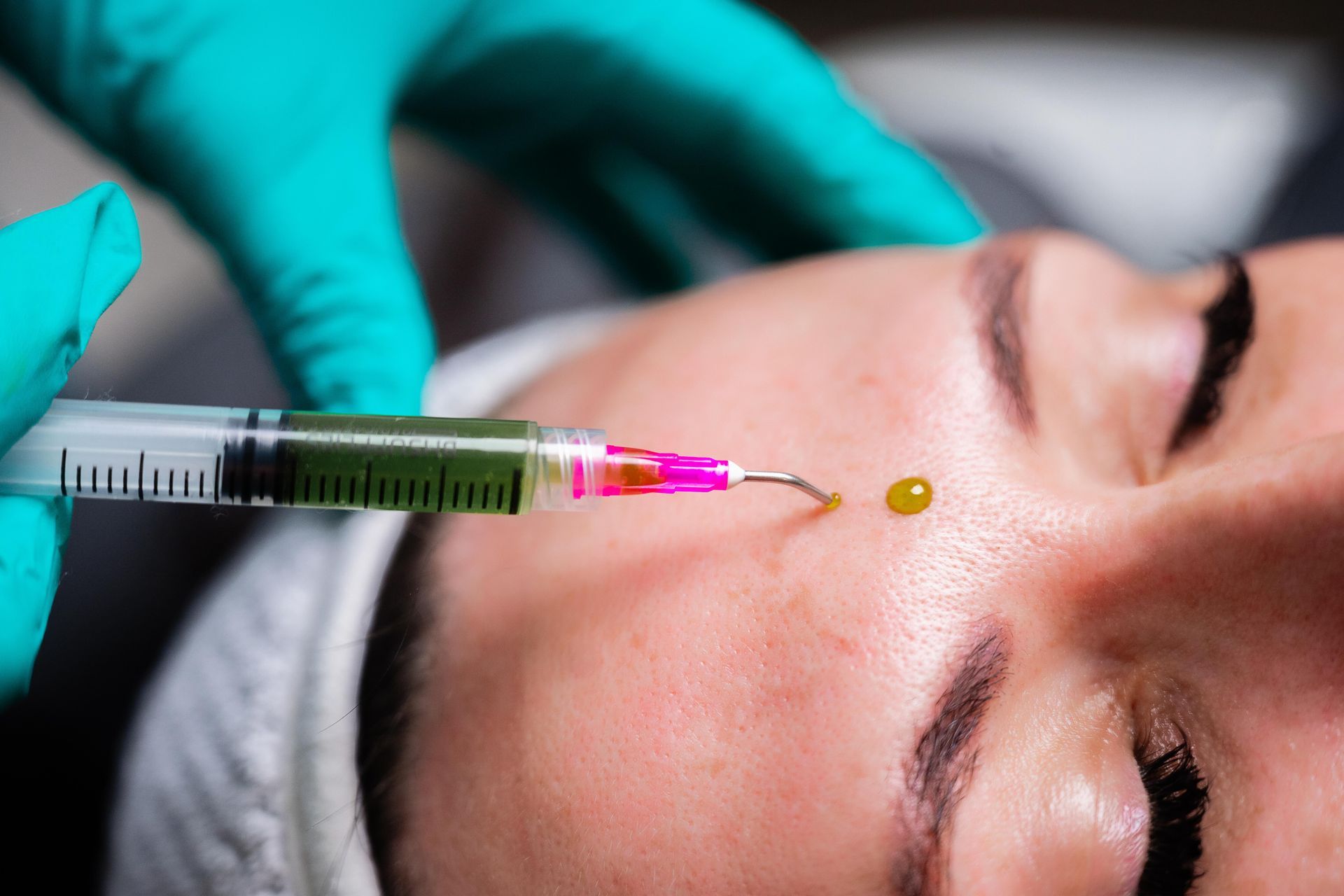 Chemical Peels Gallery