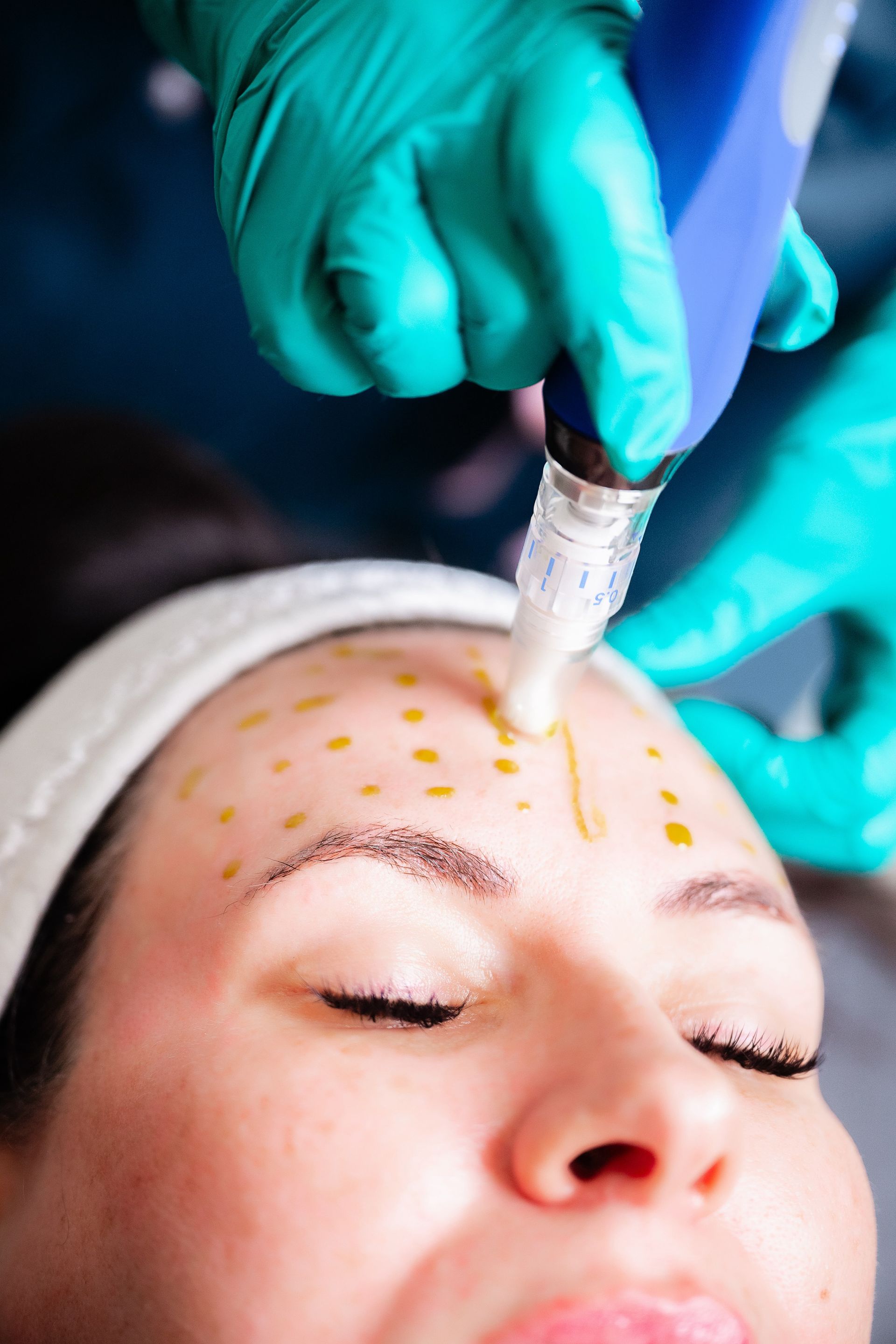 SkinPen Microneedling Gallery