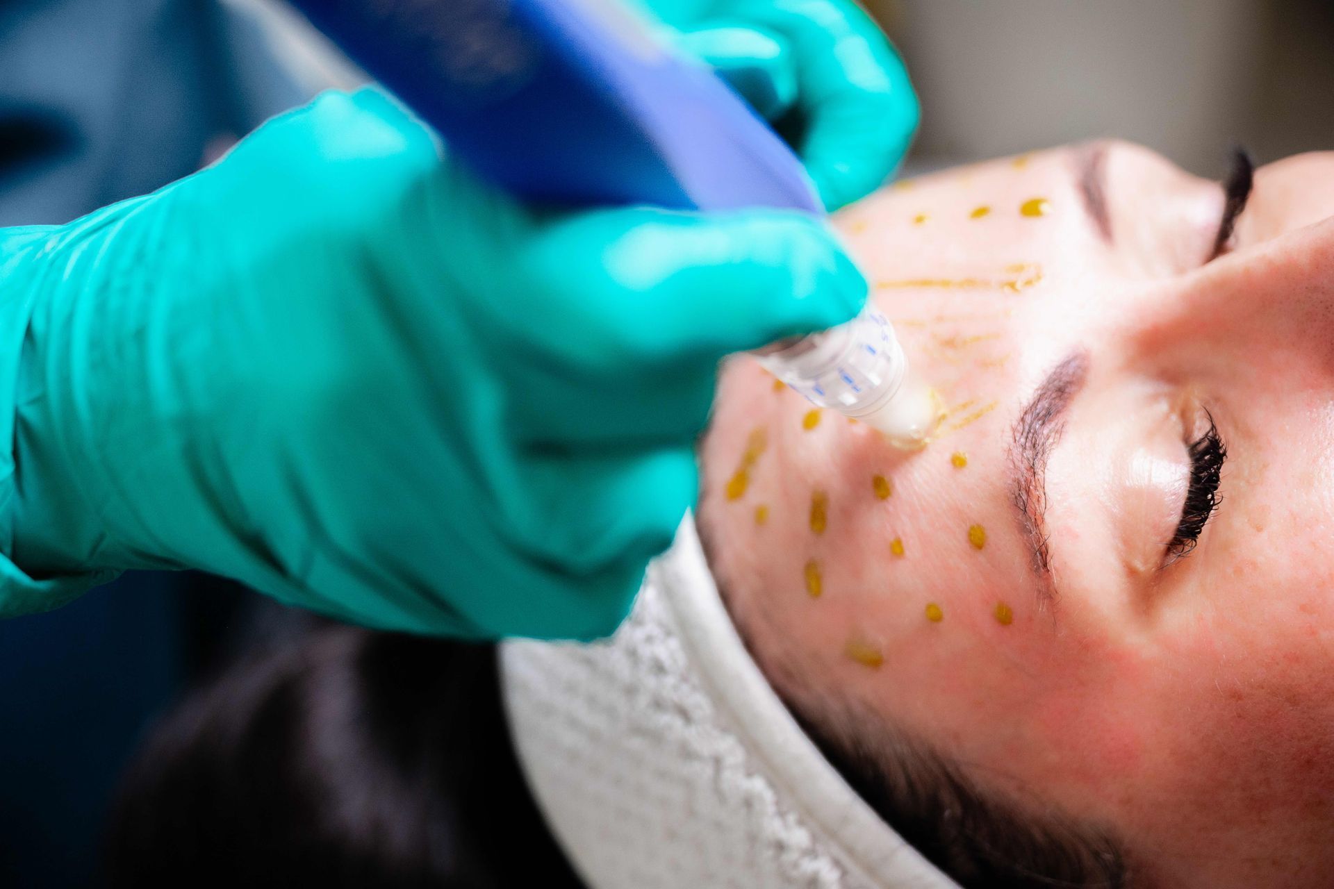 SkinPen Microneedling Gallery