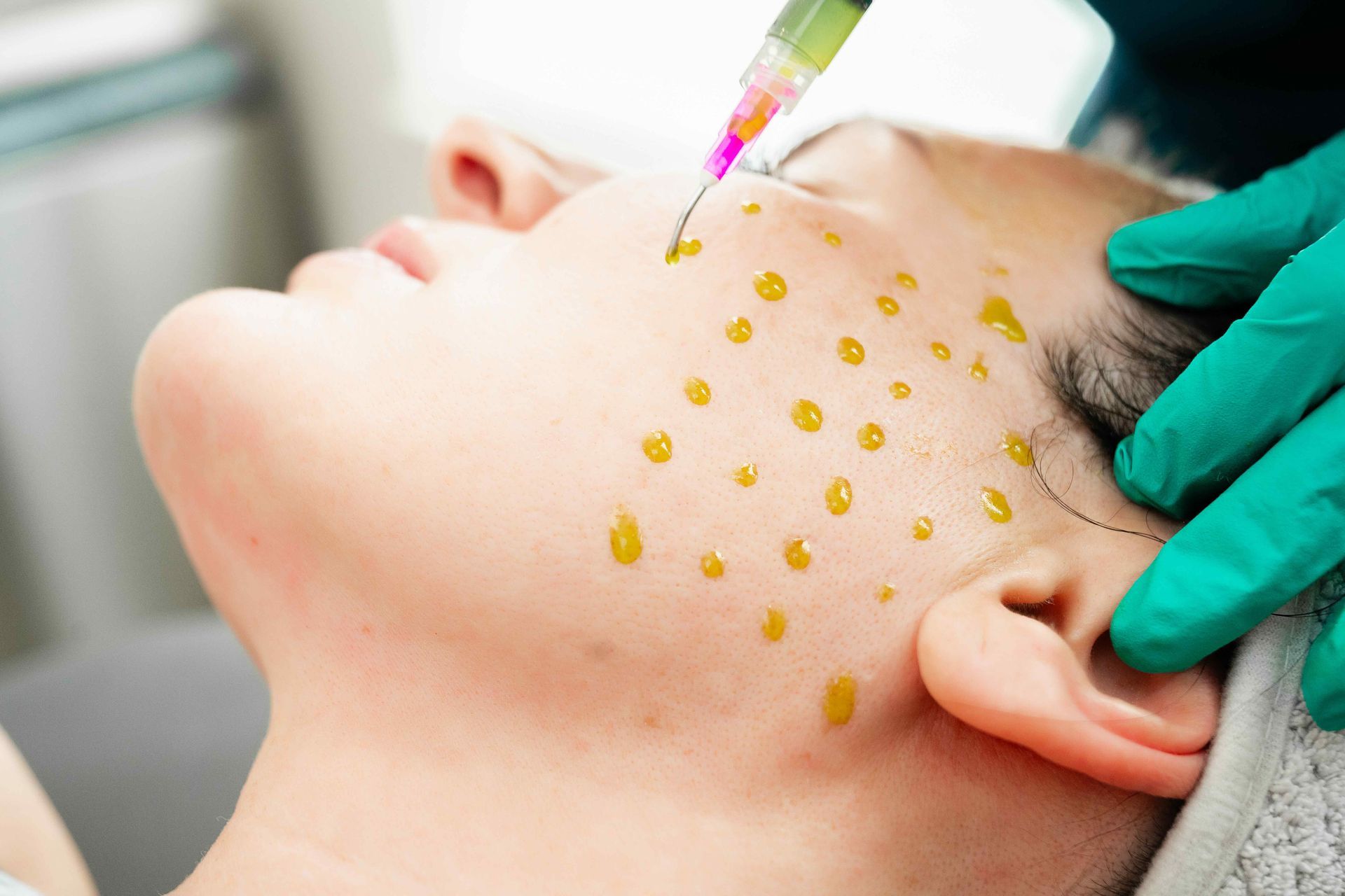 Chemical Peels Gallery