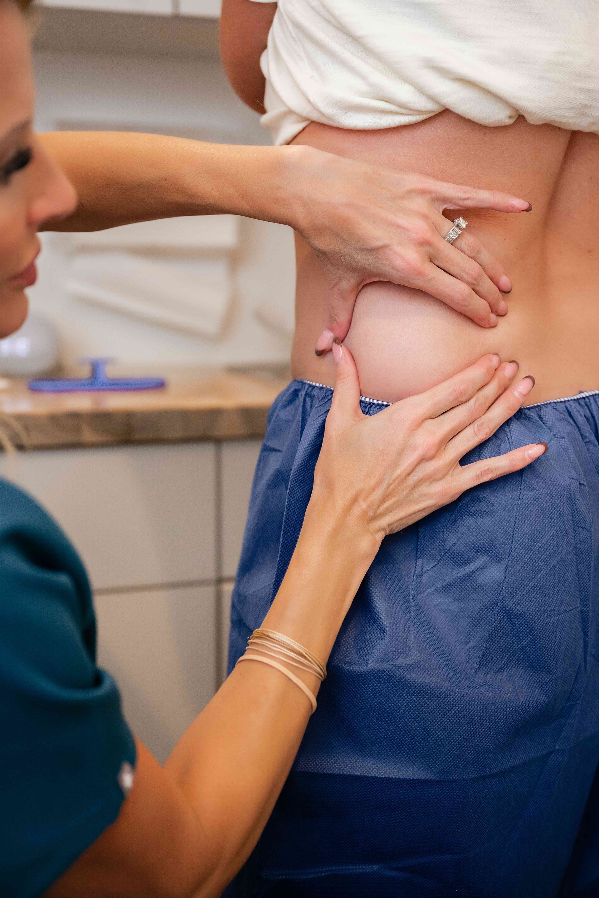 CoolSculpting Gallery