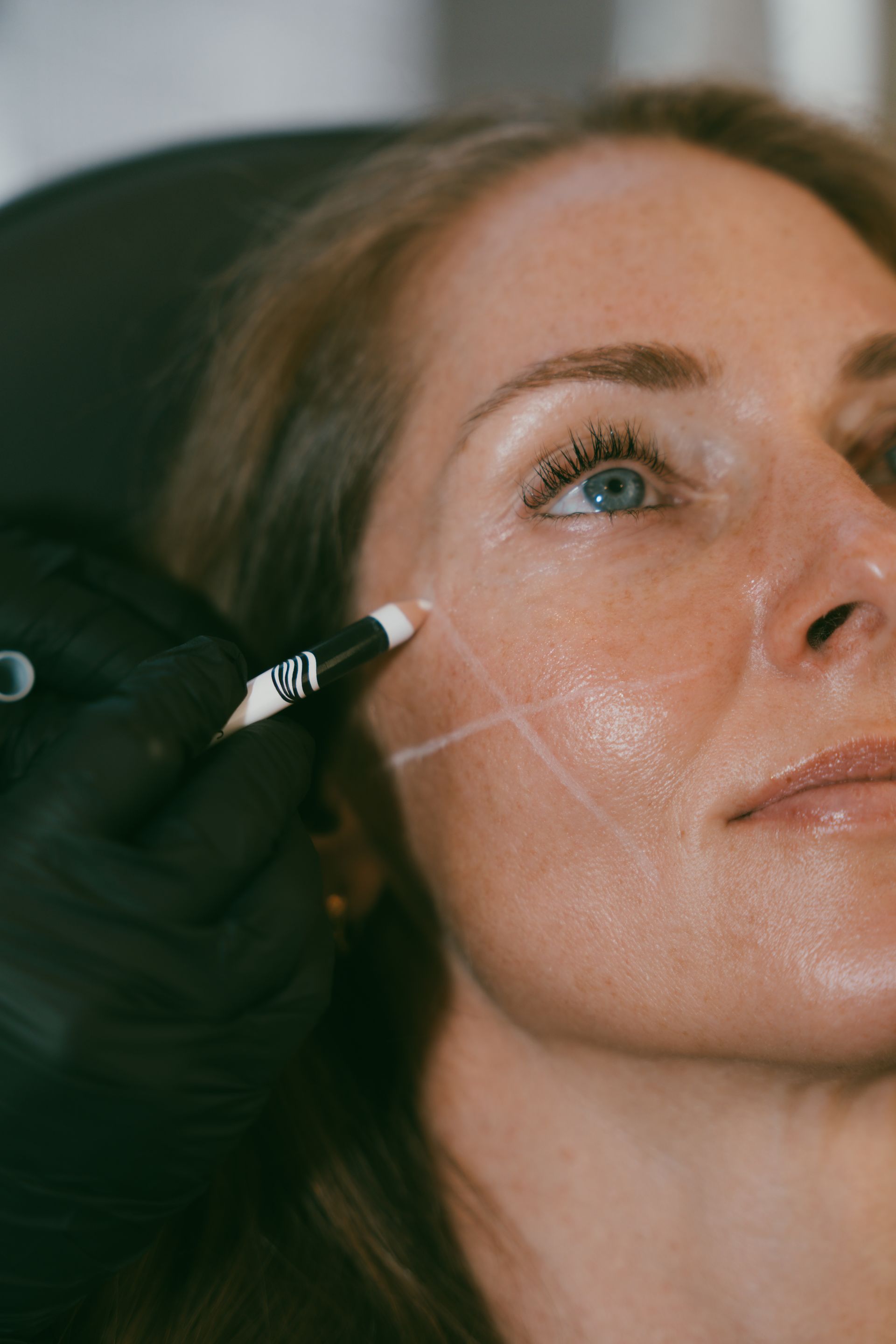 A person's face marked with lines, prepared for cosmetic injections, as a gloved hand holds a marker.