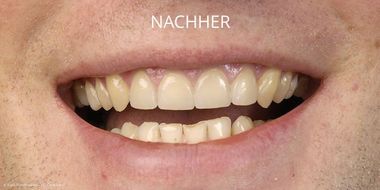 Schneidezähne nach der Behandlung mit Veneers Schneidezähne nach der Behandlung mit Veneers