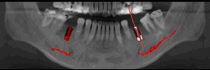 Temporary Teeth