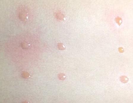 DR. SERGIO CARVAJAL ABDALA – ALERGIAS